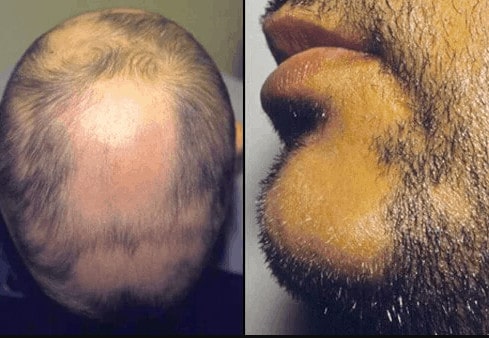 Alopecia areata barbae