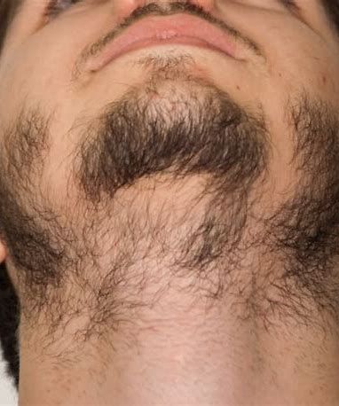 beard hair loss