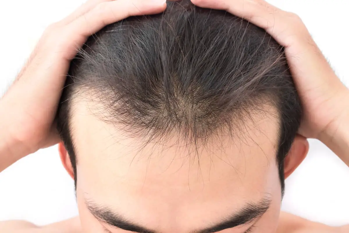 How To Fix A Bad Hairline 7 Ways Hair Regrowth Tips Bald And Beards