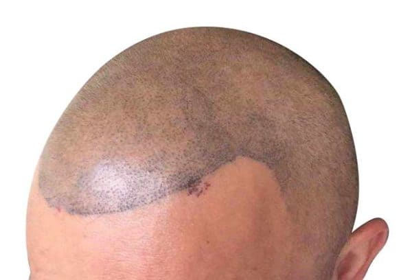 bad scalp micropigmentation