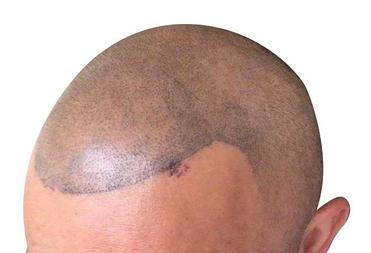 5 Scalp Micropigmentation Regrets + Botched SMP - Bald & Beards