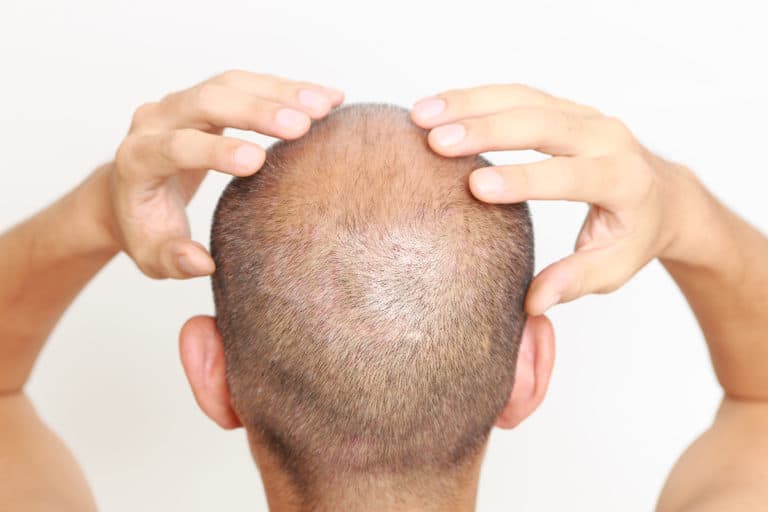 bald head lotion
