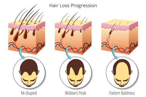 Hair Loss Progression Diagram Hair Loss Progression Diagram and Genetics role in balding and hair growth