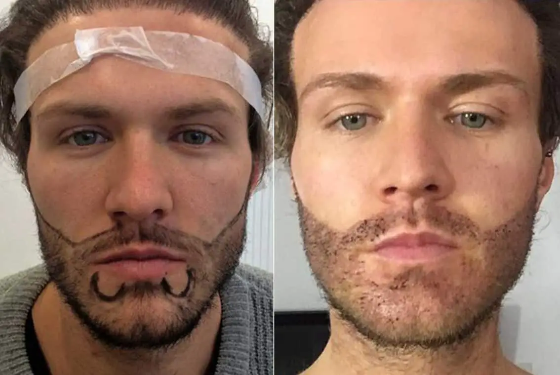 Beard Implants Before And After