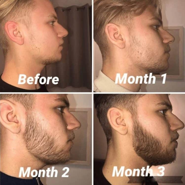 Beard roller results, before after time lapse