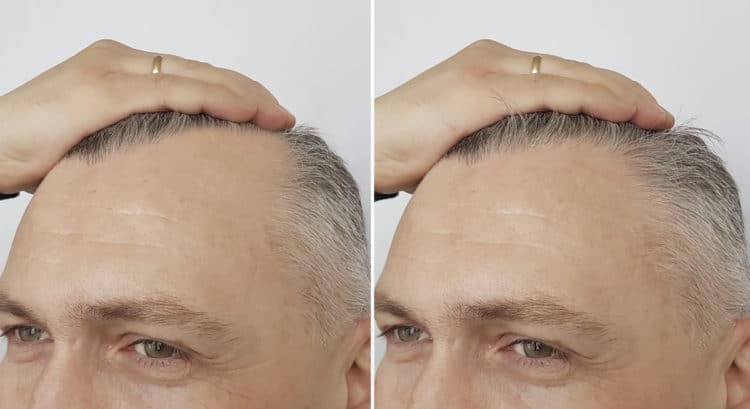 Using the best growth can dramatically improve hairline growth. 