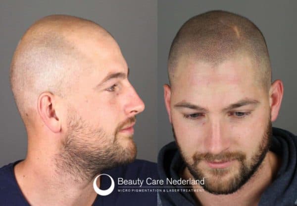 before after scalp micropigmentation SMP before and after plus pros and cons