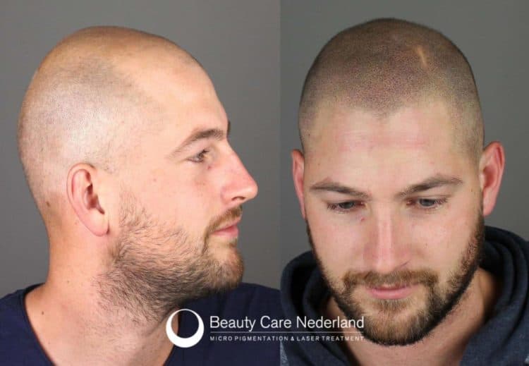 Before after scalp micropigmentation.
