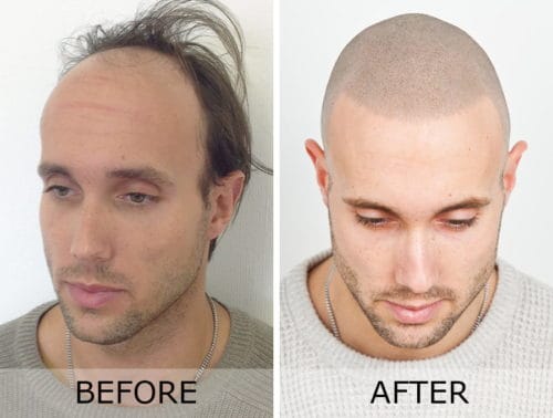 Before and after SMP procedure Before and after scalp micropigmentation (SMP)