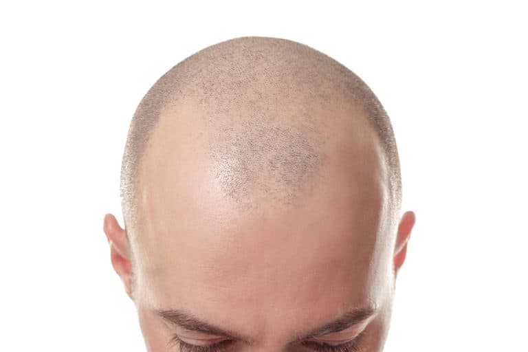 best scalp micropigmentation clinics