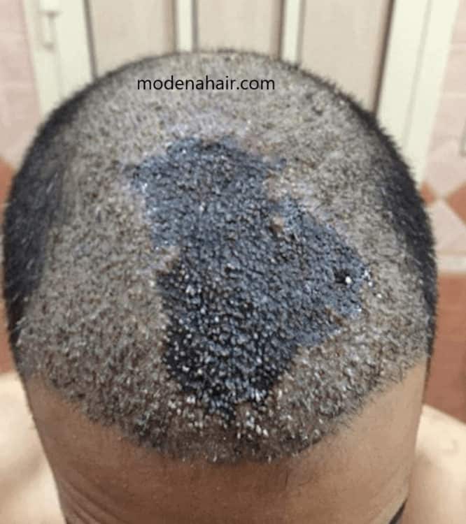 Botched scalp micropigmentation can leave a horrible result.
