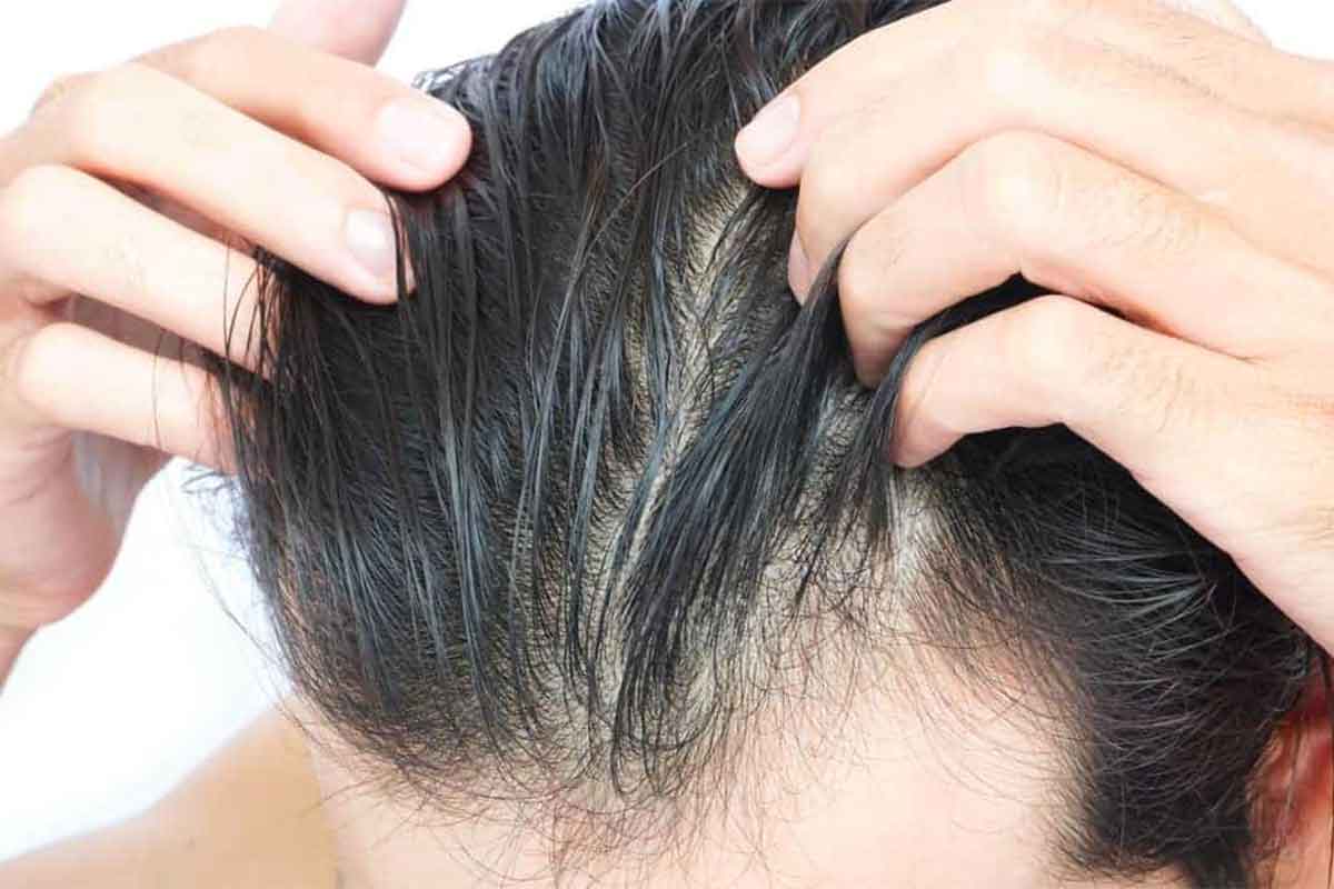 DHT - How it Causes Hair Loss, Remedies & Blockers