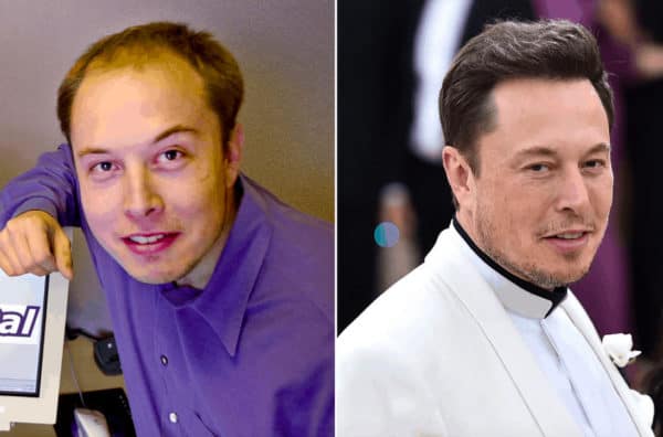 Elon Musk hair transplant Elon Musk celebrity hair transplant (before and after).