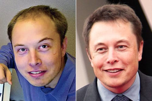 Elon Musk's before and after receding hairline Elon Musk's before and after receding hairline.