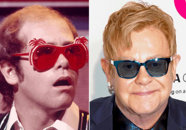 Elton John celebrity hair transplant (before and after).