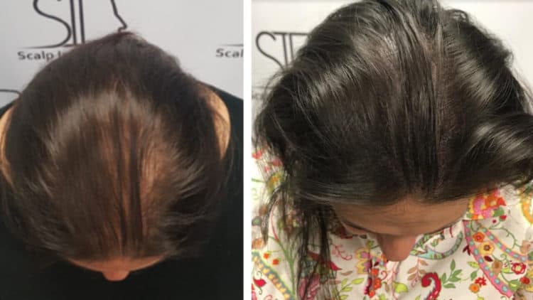 Female scalp micropigmentation shows fantastic results.