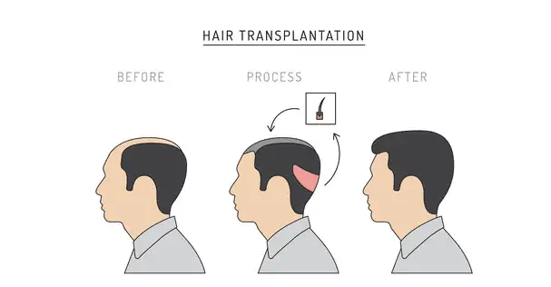 FUT Hair Transplantation
