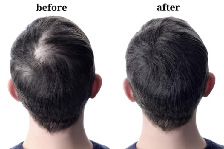 Hair fibers for men - Toppik before and after.