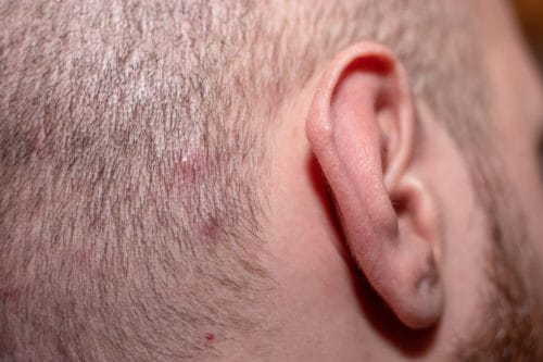 Treat Ingrown hairs on a bald head