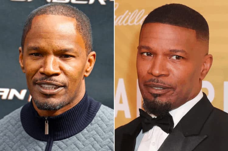 Jamie Foxx celebrity hair transplant (before and after).