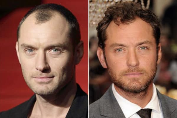 Jude Law hair transplant Jude Law celebrity hair transplant (before and after).