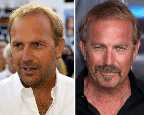 Kevin Costner celebrity hair transplant (before and after).