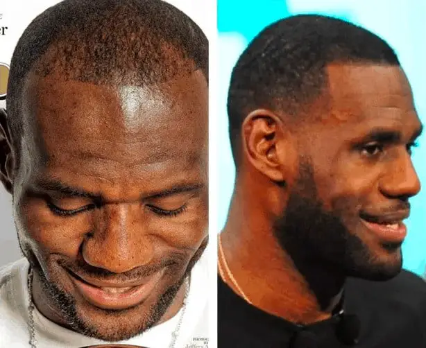 LeBron James celebrity hair transplant (before and after).