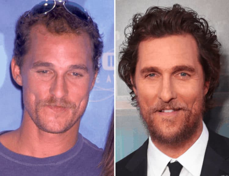 Matthew McConaughey celebrity hair transplant (before and after).