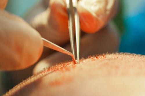 Hair Transplant Procedure FUE or FUT Hair Transplant Procedure being performed.