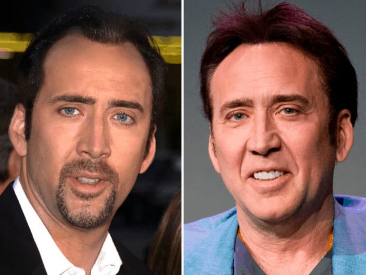 Nicolas Cage celebrity hair transplant (before and after).