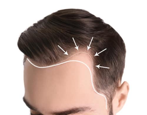 Regrow Your Hairline