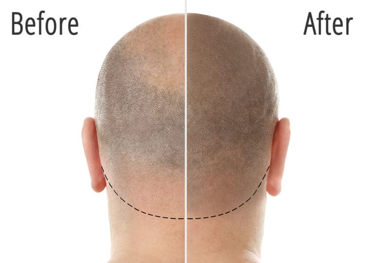 Scalp Micropigmentation Treatment Before and After 