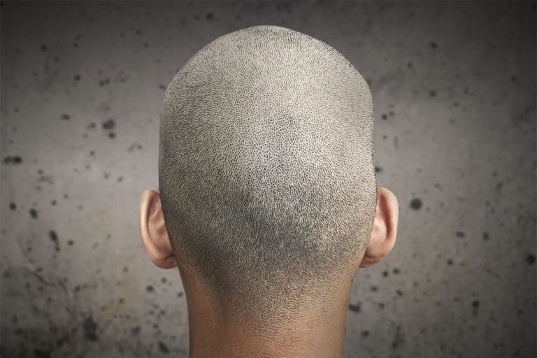 scalp micropigmentation costs