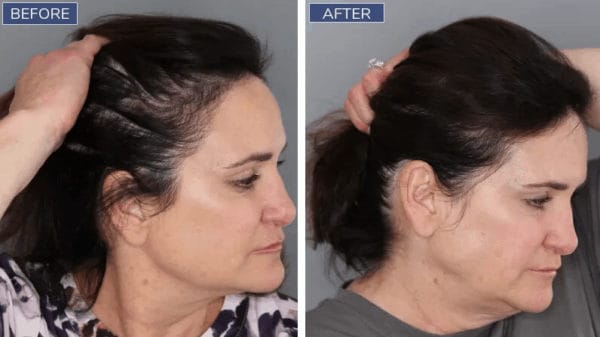 Before and after SMP for women Hairline tattoos for women are a good SMP option.