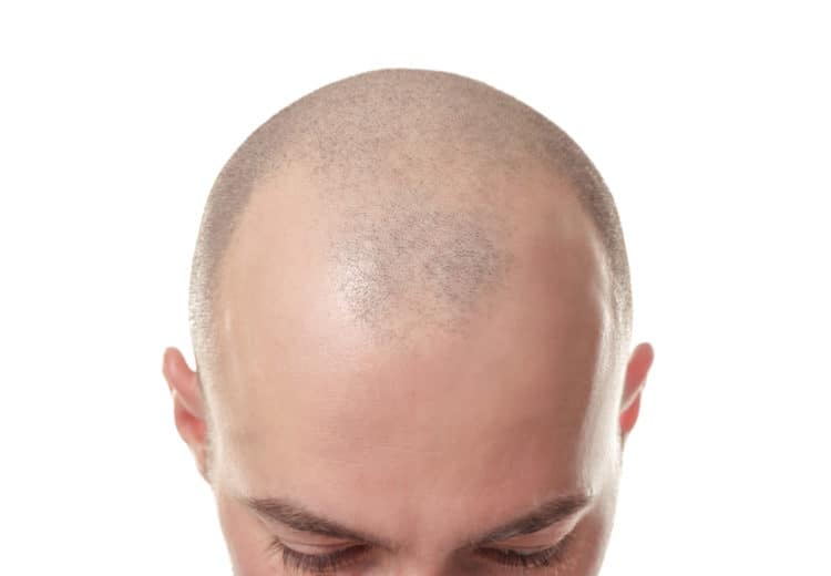 scalp micropigmentation pros and cons