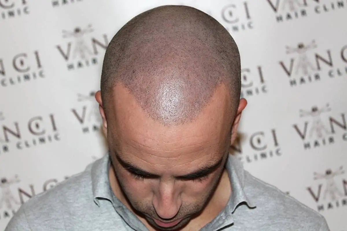 scalp micropigmentation side effects