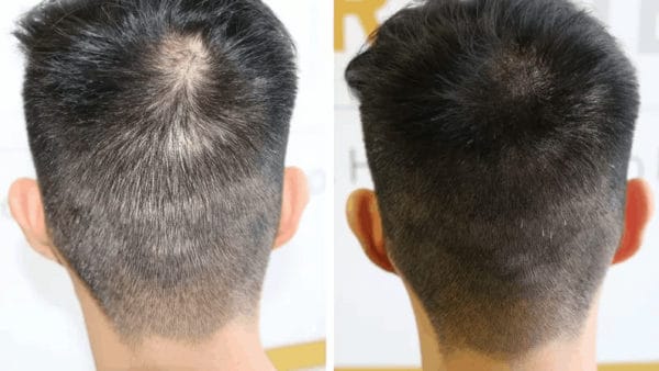 SMP and FUE combined SMP and FUE combined