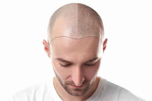 Scalp Micropigmentation (SMP) is a solution to restore your hairline - visualized.