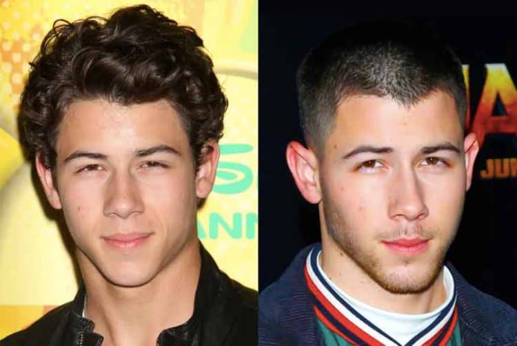 Nick Jonas before and after Hairline
