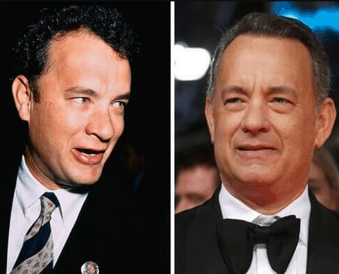 Tom Hanks celebrity hair transplant (before and after).